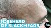 A Forehead Of Blackhead Extractions Dr Pimple Popper Mines A Patient S Head