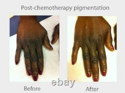 Cyspera (Cysteamine) Intensive Skin Pigmentation Cream Pigment Corrector