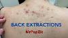 Tons Of Blackheads On The Back Acne Extractions Blackheads And Whiteheads Mining Pore Dirt